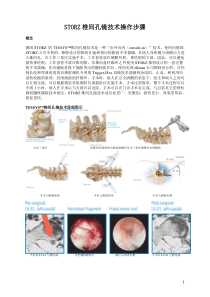 全部步骤(椎间孔镜)手术