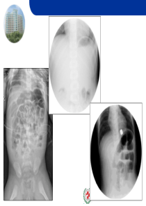 肠套叠X线诊断与复位