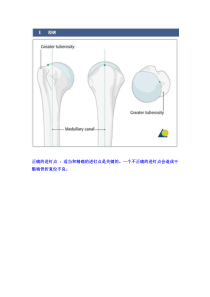 手术-肱骨近端骨折A2型髓内钉固定术