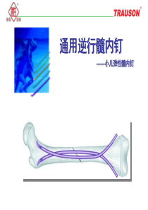 逆行髓内钉—小儿弹性髓内钉