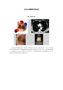 EBUS淋巴结定位