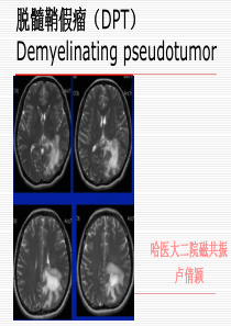 脱髓鞘假瘤MRI诊断