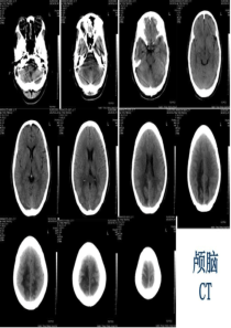 可逆性后部白质脑病综合征RPLS图文