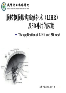 腹腔镜腹股沟疝修补术