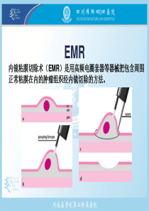 内镜下EMR