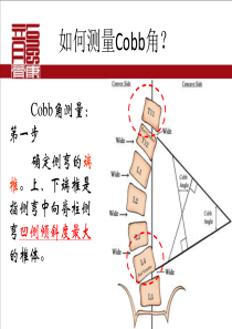 Cobb角测量