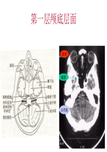 颅脑基本病变的CT诊断.