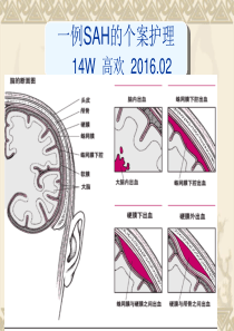 蛛网膜下腔出血的个案护理最终