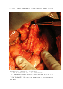 肝脏手术肝门部胆管癌根治性切除术及胆囊癌根治术