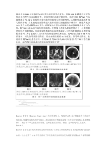 脑出血的MRI信号特征与血红蛋白的不同形式有关