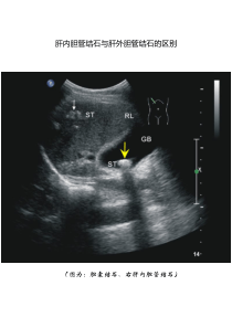 肝内胆管结石与肝外胆管结石的诊断