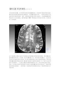 多发性硬化