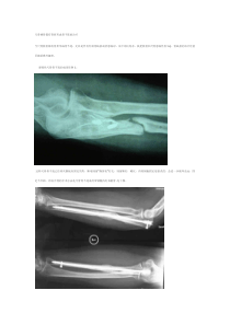 尺骨桡骨都有骨折形成骨不连的治疗