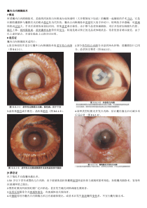 囊内白内障摘除术