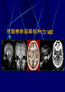 颅脑横断层解剖和CTMRI