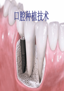 口腔种植义齿技术