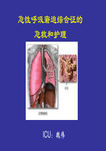 62急性呼吸窘迫综合征的急救和护理