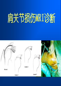 67肩关节损伤MRI诊断