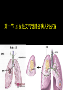 第二章第十节  原发性支气管肺癌病人的护理