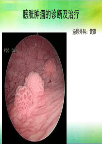 膀胱肿瘤的诊断及治疗