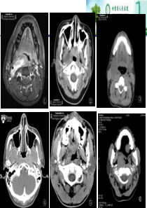 咽旁间隙病变的影像诊断及鉴别病例
