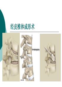 经皮椎体后凸成形术