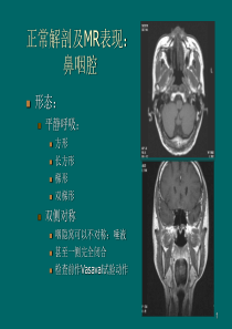 鼻咽癌MR诊断  2018