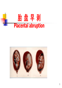 胎盘早剥疾病查房_PPT