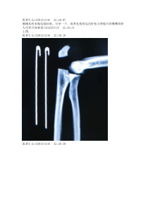 带孔钩的克氏针治疗尺骨鹰嘴骨折 Microsoft Word 文档 (5)