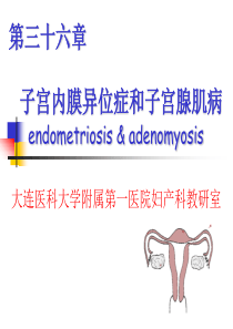 子宫内膜异位症和子宫腺肌病