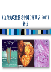 2017年自身免疫性脑炎中国专家共识解读(精华版)