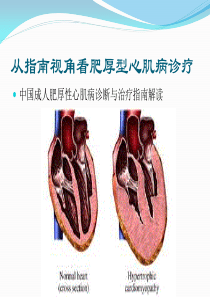 成人肥厚型心肌病诊断与治疗