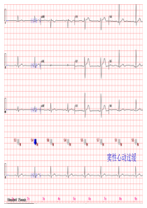 心电图常见正常和异常心电图图谱
