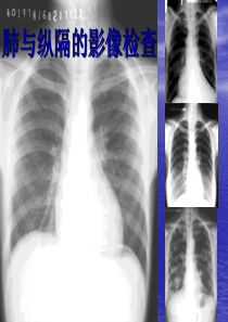 学看胸部CT