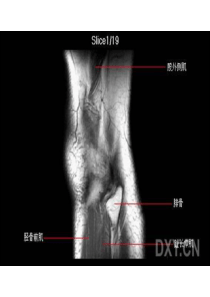 膝关节正常MRI解剖图谱resonance关节