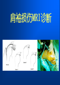 肩袖损伤MRI诊断