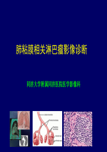 肺粘膜相关淋巴瘤影像特征