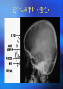 颅骨x线诊断