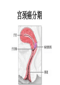 宫颈癌分期