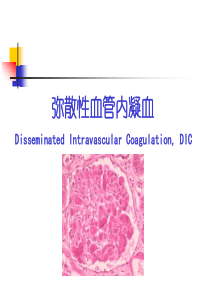 DIC的诊断及治疗