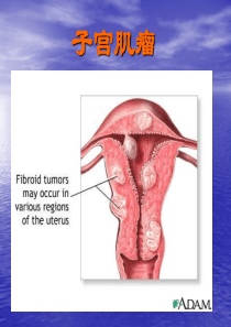 子宫肌瘤课件2