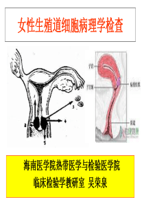 宫颈癌