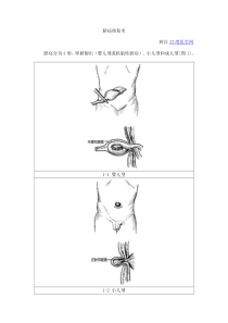 脐疝修复术