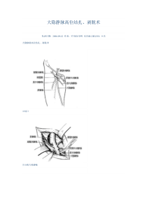 大隐静脉高位结扎、剥脱术
