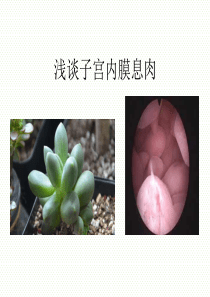 子宫内膜息肉ppt