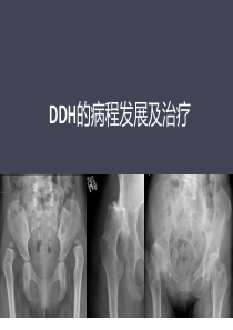 DDH的病程发展及治疗