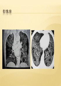 肺泡蛋白沉积症.ppt2015-9-6