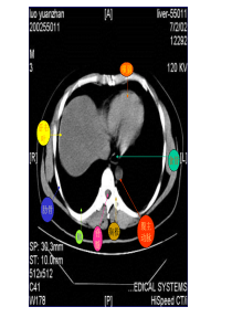 教你如何看腹部CT