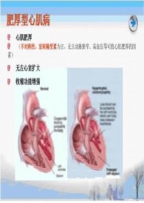 肥厚型心肌病