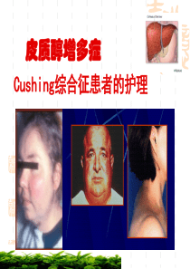 Cushing综合征-整理